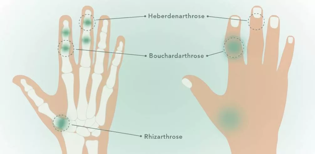 Abbildung Arthrose der Hand einen fortschreitenden Verschleiß der Gelenkknorpel